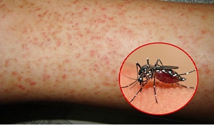 Một số thông tin về bệnh sốt xuất huyết Dengue